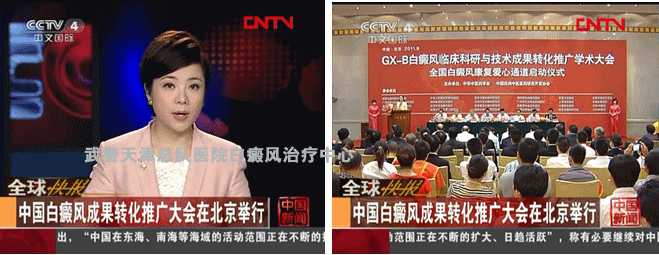 CCTV4报道：白癜风成果转化推广大会在北京举行